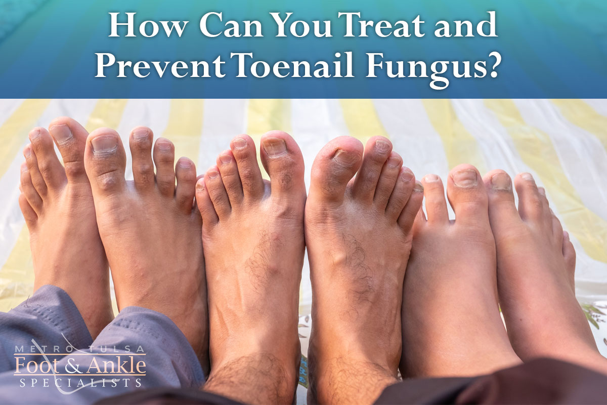 How Can You Treat And Prevent Toenail Fungus Mtfas