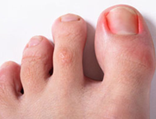 The Ugly Truth About Ingrown Toenails: Causes, Symptoms, and Treatments