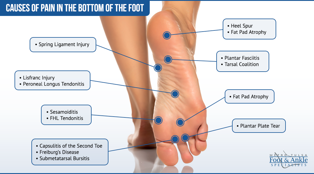 bottom foot pain chart 