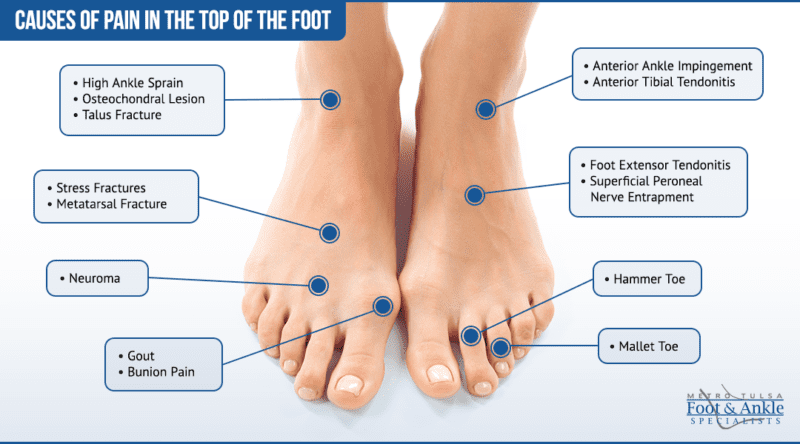 Foot Pain Chart | Metro Tulsa Foot & Ankle