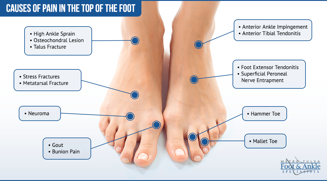 top foot pain chart 